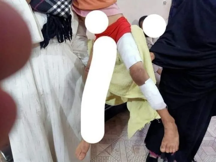 مفيش إنسانية .. عامل يُعذب ابنته بالحرق بجريد النخيل في قنا